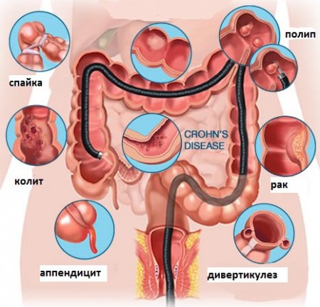 Изображение того, какие болезни кишечника выявляет колоноскопия